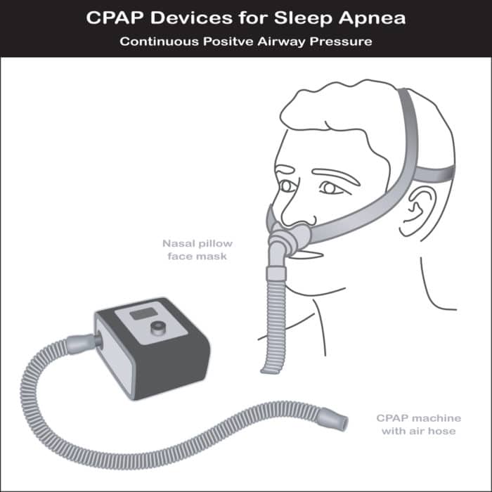What is a CPAP Machine? – A motor to blow air, a mask, and a hose What is a CPAP Machine - Picture showing the basic machine parts