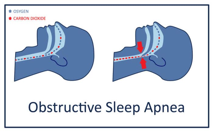 Obstructive sleep apnea, a common sleep disorder, restricts airflow and disturbs sleep obstructive sleep apnea interrupts breathing
