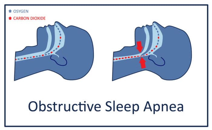 obstructive sleep apnea interrupts breathing