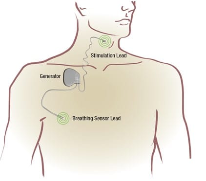 cartoon illustration showing Inspire implant system for sleep apnea treatment