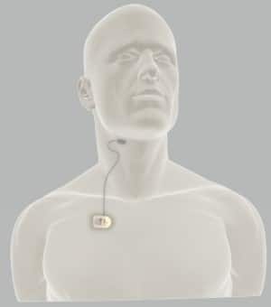 drawing showing the THN device which is one of the latest sleep apnea treatments