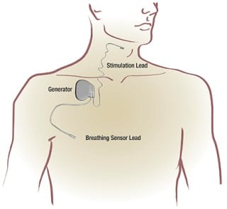 Graphic showing location of breathing pacemaker device which may help with cpap spouse complaints