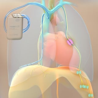 cartoon drawing of the remede device which is one of the  latest sleep apnea treatments