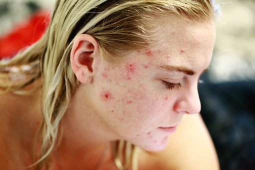 women with severe facial acne wondering if insomnia can make acne worse