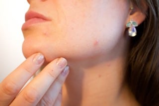 Older adults can get acne too