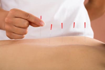 photo of acupuncture needles used to help sleep apnea