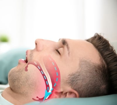 picture showing the narrow airway in a person with sleep apnea